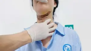 Nữ sinh ở Quảng Trị bị dây giăng ngang đường cứa vào cổ khi đi học về